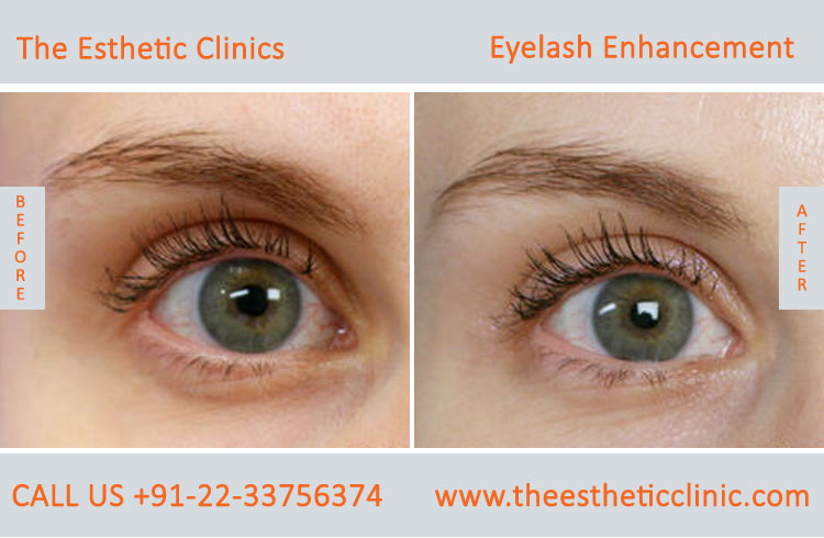 Eyelash Enhancement Surgery, Latisse Eyelash Treatment before after photos in mumbai india (6)